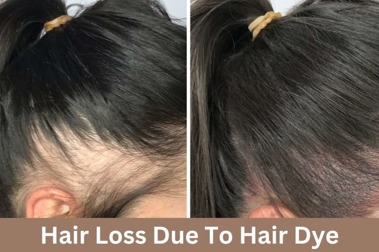 Hair Loss Due To Hair Dye: Will It Grow Back?